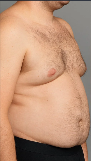 Before Fat Dissolving Treatment