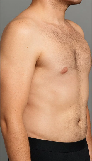 After Fat Dissolving Treatment