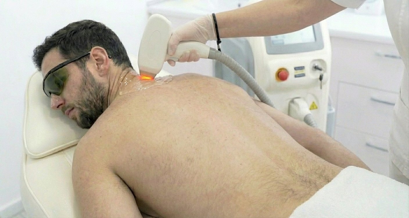 Male Back of Neckline Laser Treatment