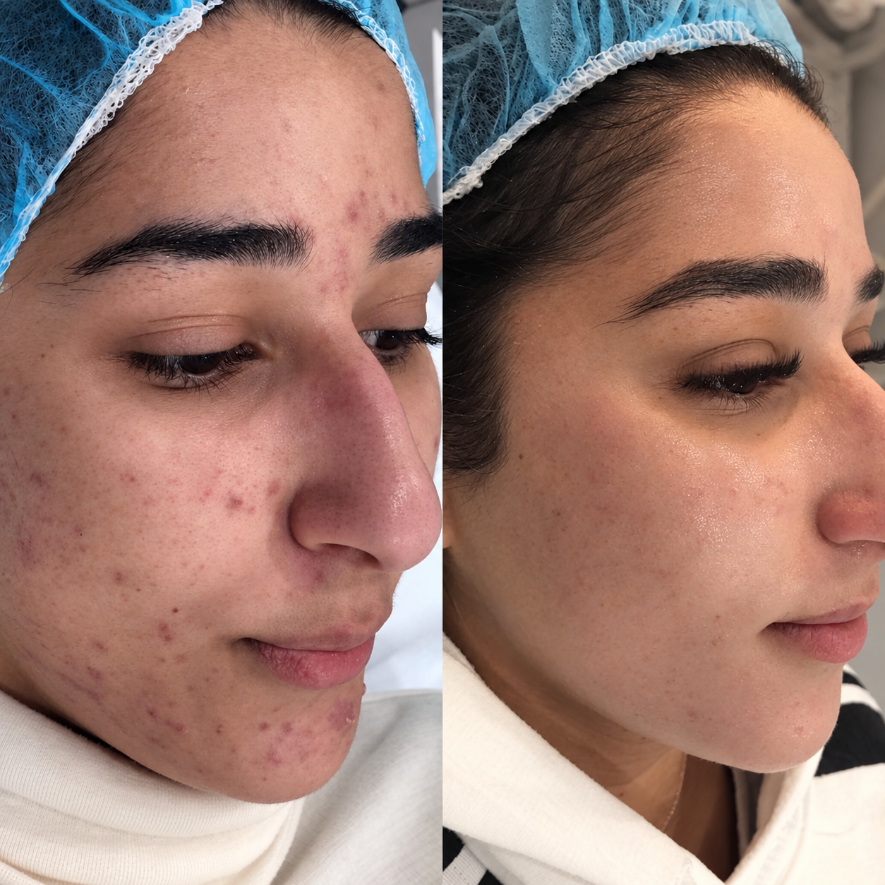 IPL Acne Clarity