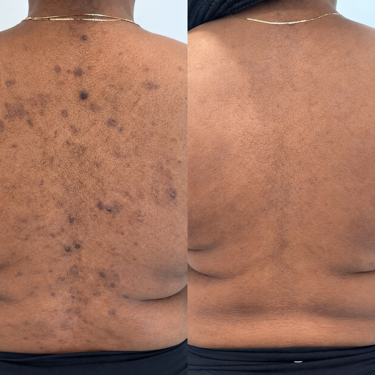 Plasma Pen Treatment