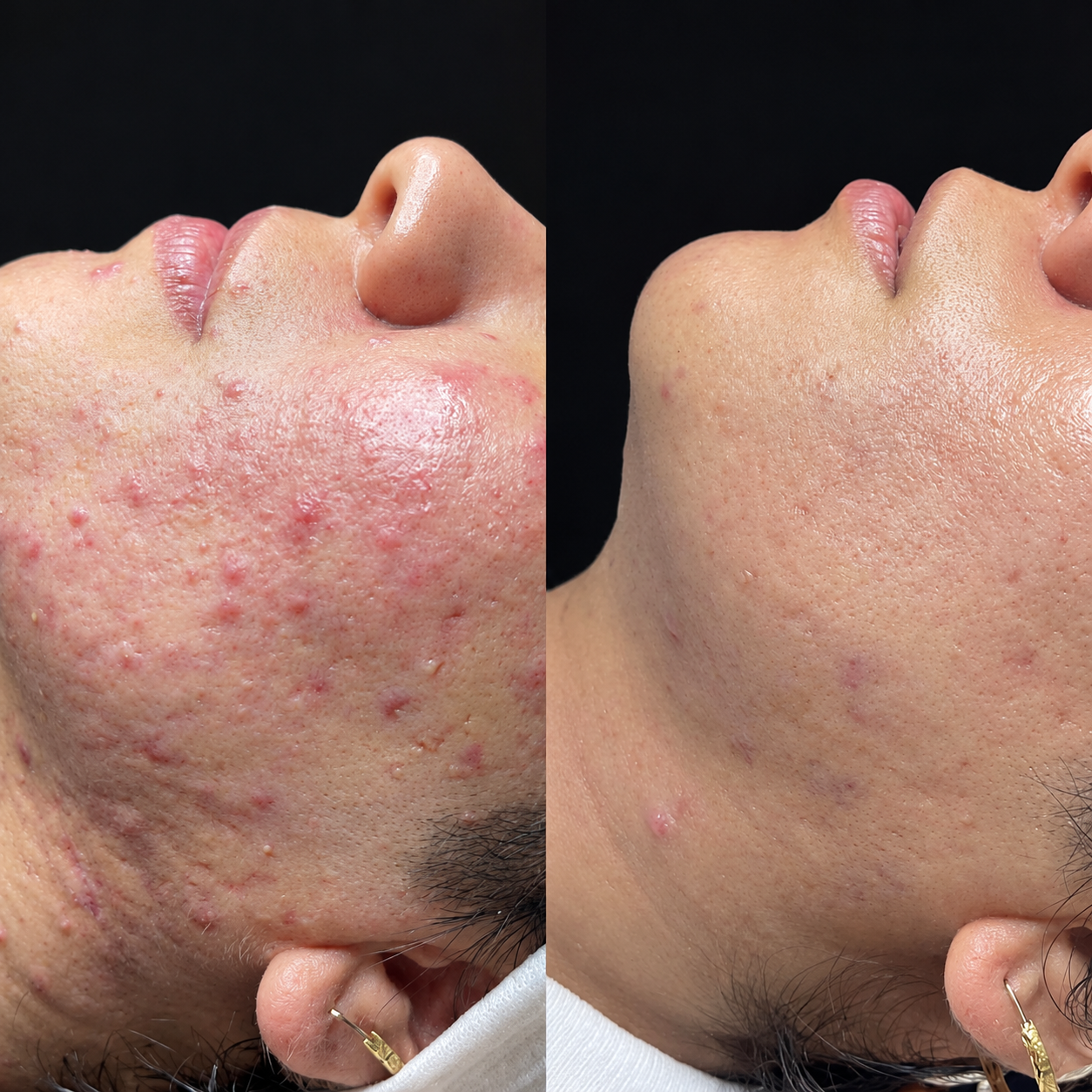 Radiofrequency